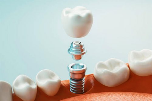 Cirurgia de implantes dentários